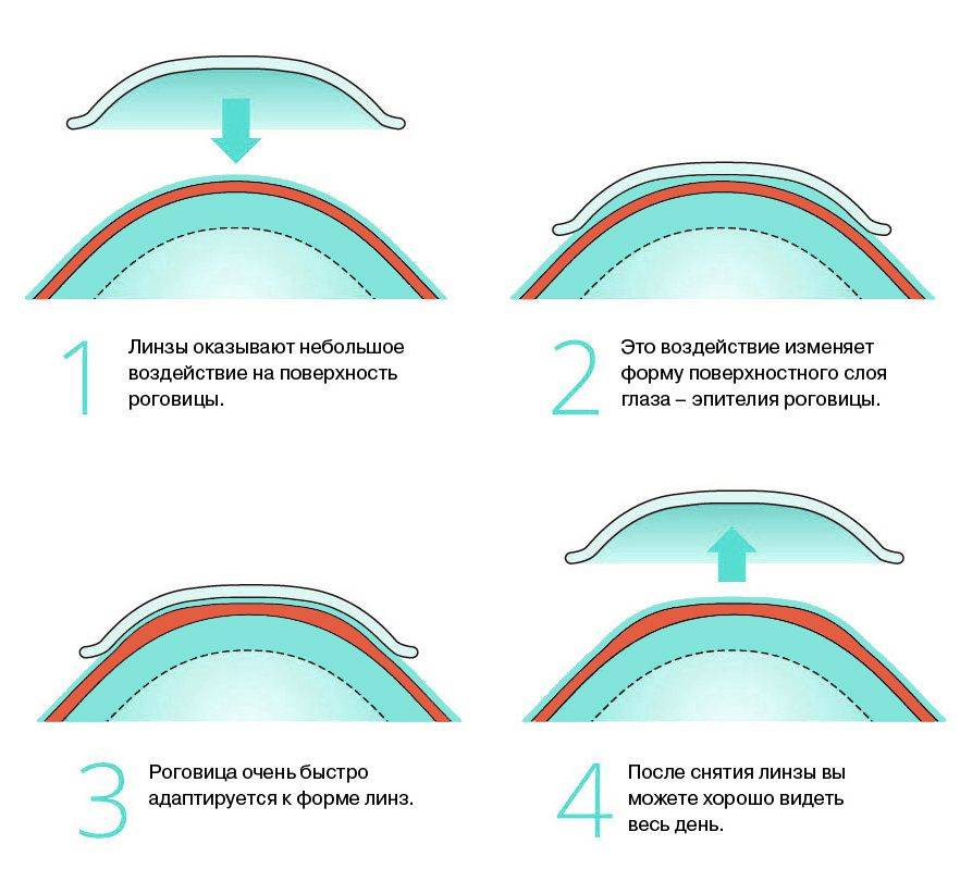 Контактные линзы: вред и польза для глаз (обычные, цветные и ночные линзы)